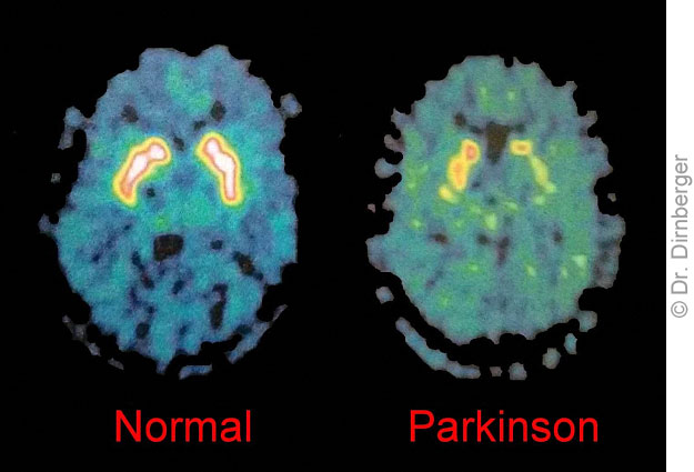 Parkinsonsche Krankheit